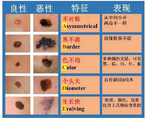 黑色的痣|痣